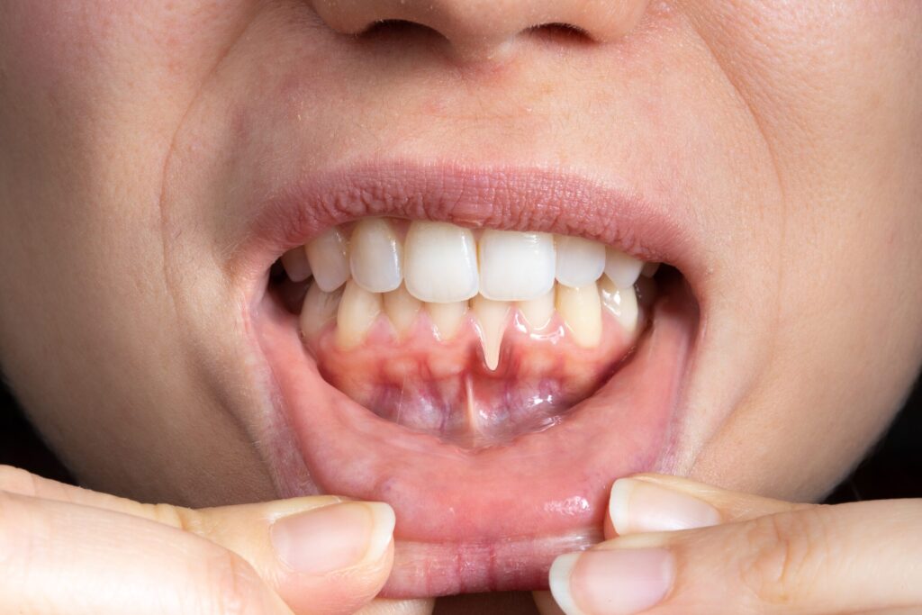 Preparing for teeth whitening with receding gums High Wycombe